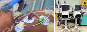 Nuevas maquinas UCI pediatrica en el Hospital St Damien donadas por Fundacio Ordesa | Fundación NPH